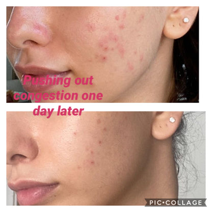 5x Carboxy Korean Facial plus HYDRA deep clean &amp; Led Light